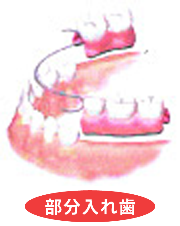 部分入れ歯