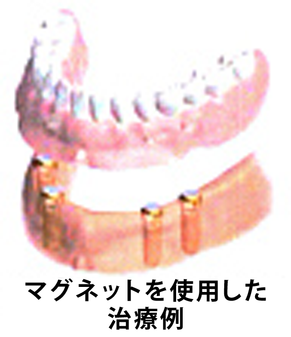 マグネットを使用した治療例