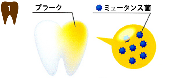 1プラーク（歯垢）