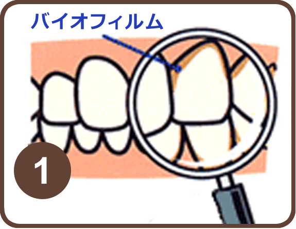 歯科医院で歯のクリーニング　PMTC