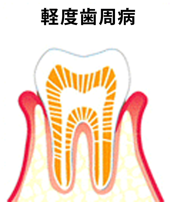 軽度歯周病