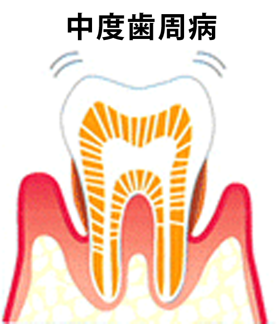 中度歯周病