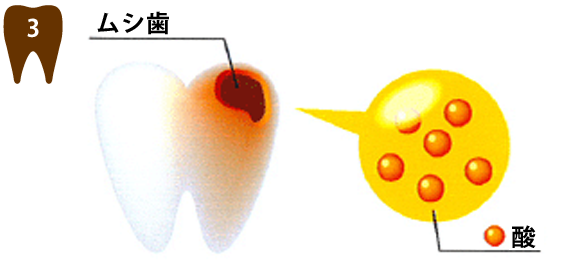 3ムシ歯