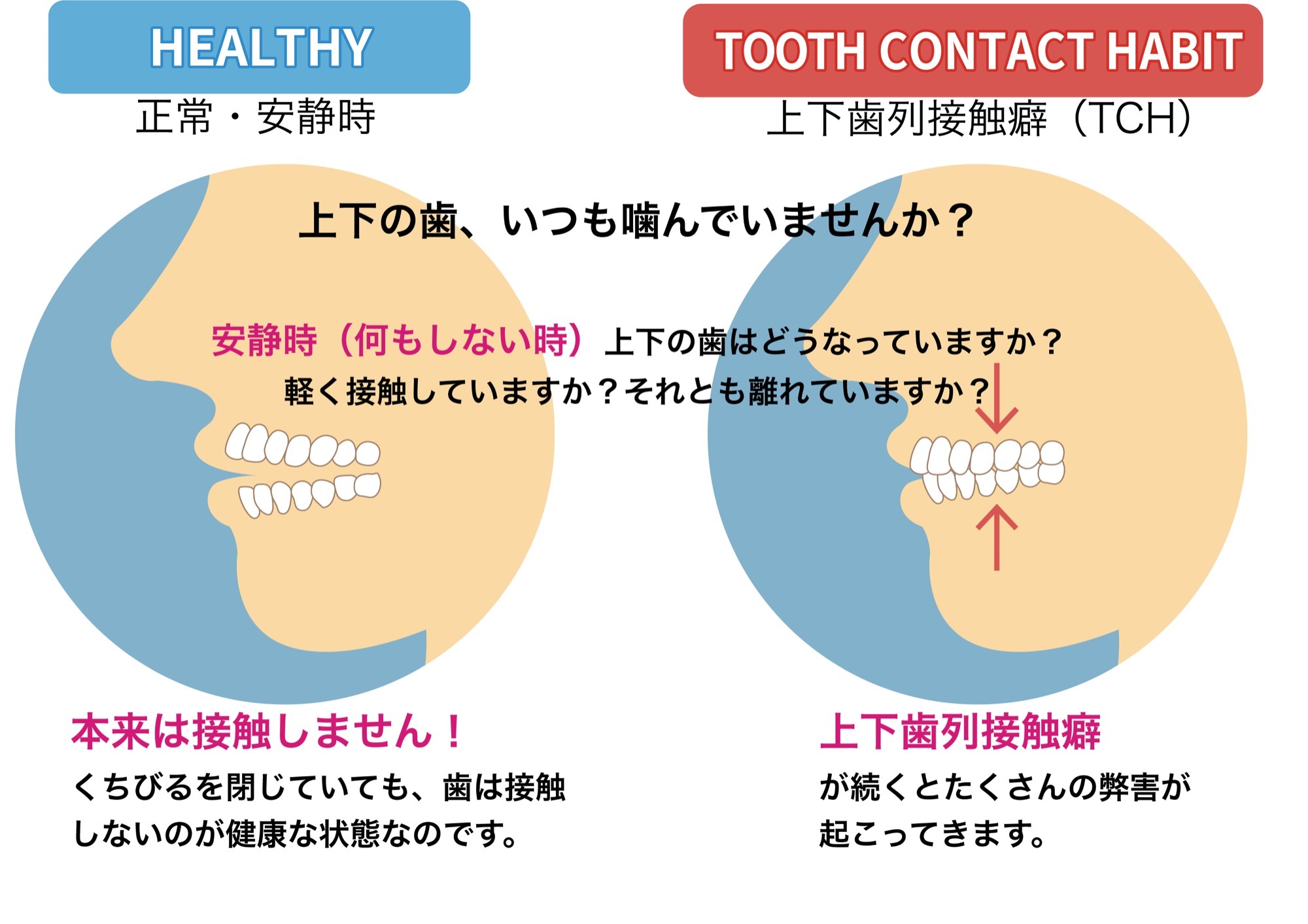 噛みしめ・上下歯列接触癖・アブフラクション