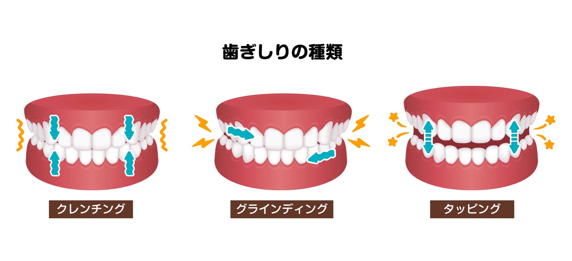 異なる歯ぎしりのタイプ